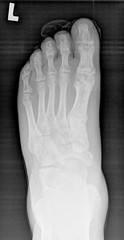 After treatment with Herbert screw - x-ray.