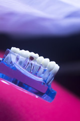 Dental tooth decay problem