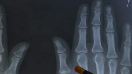 Doctor examining the x-ray of the hand. Arthritis or arthrosis