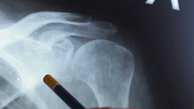 X-ray of the diseased shoulder joint. X-ray of a diseased shoulder joint. The doctor is studying the picture