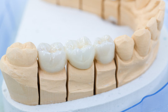 Im Dentallabor: Prothesensattel mit Zahnersatz