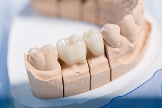 Prothesensattel mit Zahnersatz im Zahnlabor