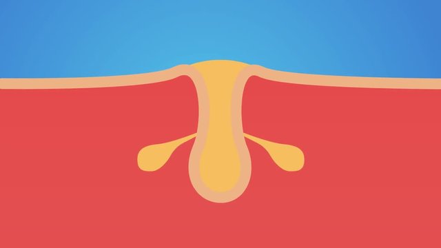 Acne and Pimples, stages of development graphic / skin