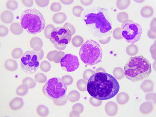 White blood cells in in blood smear, analyze by microscope
