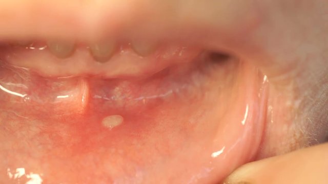 Disease in the mouth. Stomatitis into mouth on the lower lip. Close-up