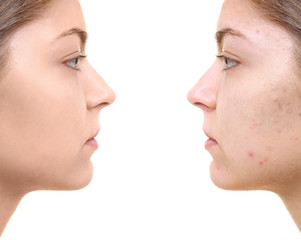 Beautiful young woman with problem skin on white background