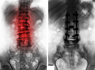 Spondylosis . Before and After surgery