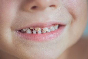 close up shot of baby teeth with caries