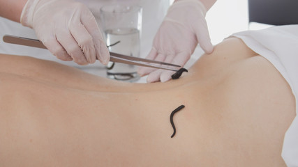 Doctor doing procedure of hirudotherapy for blonde young woman