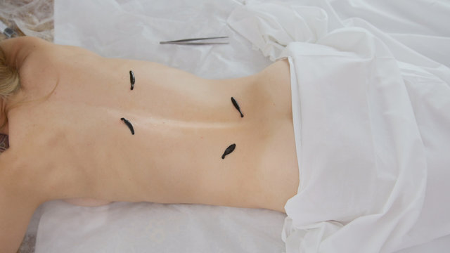 Top view - hirudotherapy for blonde young woman