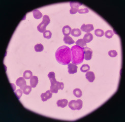 blast cell on blood smear.
