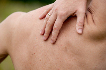 Women with skin pigmentation on back