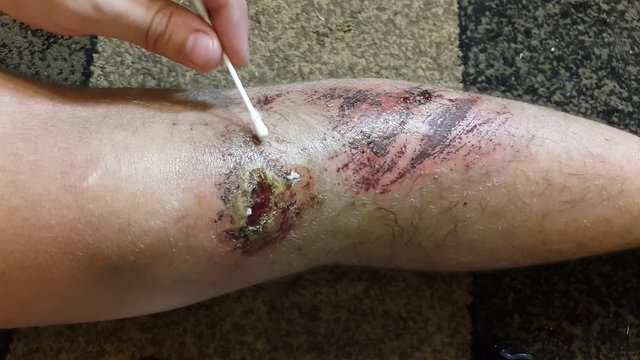 A wound on the leg of a man. First aid