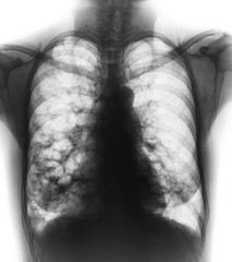 Bronchiectasis .  X-ray chest show multiple lung bleb and cyst due to chronic infection . Front view