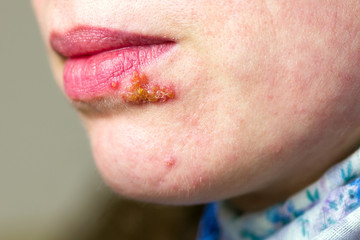 Herpes on lip