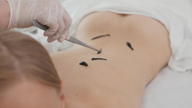 Procedure of hirudotherapy for blonde young woman