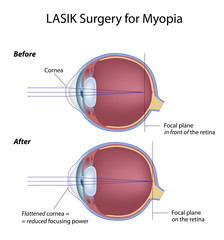 Lasik eye surgery for myopia before and after - obrazy, fototapety, plakaty