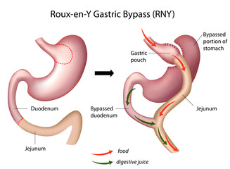 Roux-en-Y Gastric Bypass (RNY) surgery