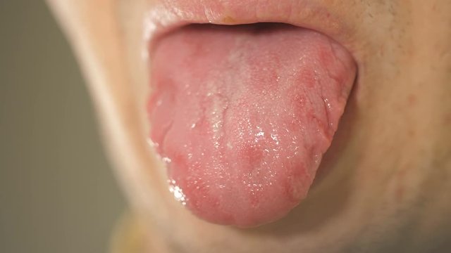 Man showing white tongue