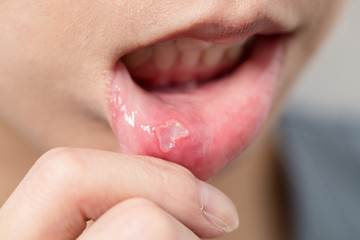 Woman suffer from aphtha on mouth