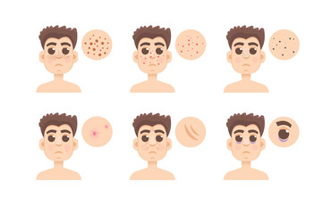 Men skin problem. Acne men. Vector illustration.