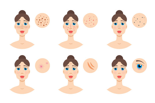 Woman with skin problem, acne. Vector illustration