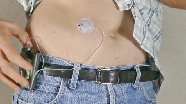 A diabetic disconnecting insulin pump set with cannula. Closeup, UHD