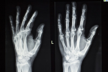 Hand fingers xray test scan