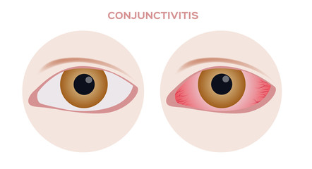 Conjunctivitis.  pink and red inflammation eye 