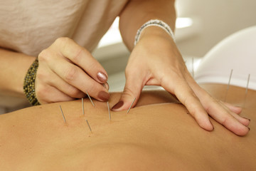Master is injecting steel needles during procedure of acupuncture therapy - obrazy, fototapety, plakaty