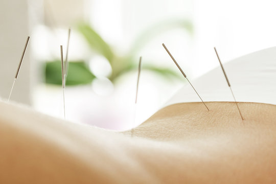 Female back with steel needles during procedure of acupuncture therapy