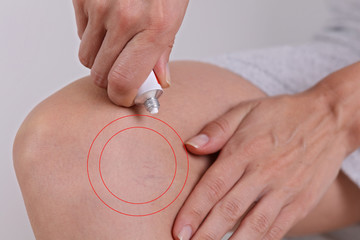 Fototapeta premium Woman appying Varicose Vein Cream close up