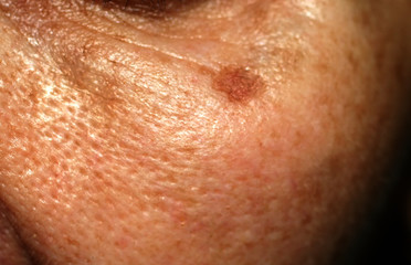 Fototapeta premium 1237980 Brown stain on the face. Pigmentation on the skin