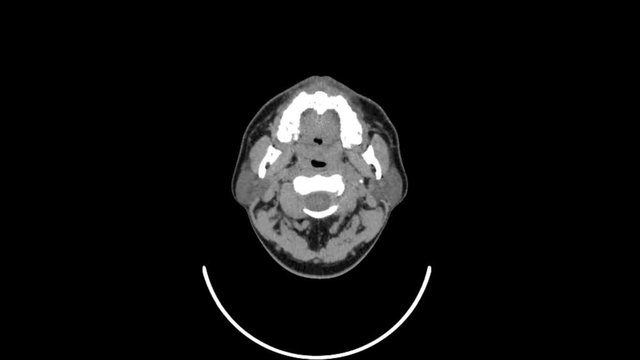 ct scan of upper neck top view smooth motion