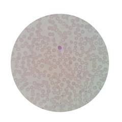 Microscopic examination of thin blood films smear from malaria infected patients present  morphology of malaria parasite in human red blood cells.