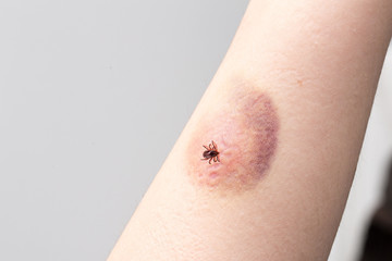 Tick bite on woman arm causing infection with hematoma