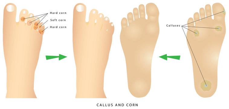Corns and calluses