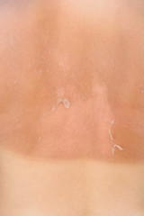Back of the girl with a sun tan. Back with protective cream, back without protective cream.