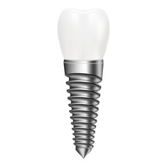 Dental Implant Isolated On A White Background. Vector Illustration. Stomatology. Creative Medical Concept