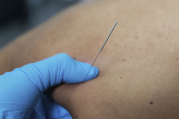 Tratamiento de Acupuntura 