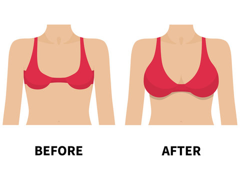 Female breast before and after plastic surgery