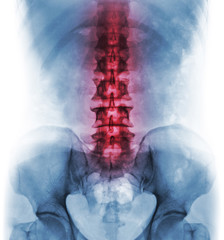 Inflammation of lumbosacral spine . Concept of vertebral care