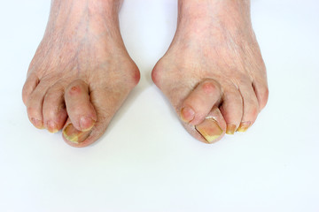 Medetcin, valgus bunion, leg with deformity valgus hallux (Bunion), the consequence of refusal of treatment, space for text - obrazy, fototapety, plakaty