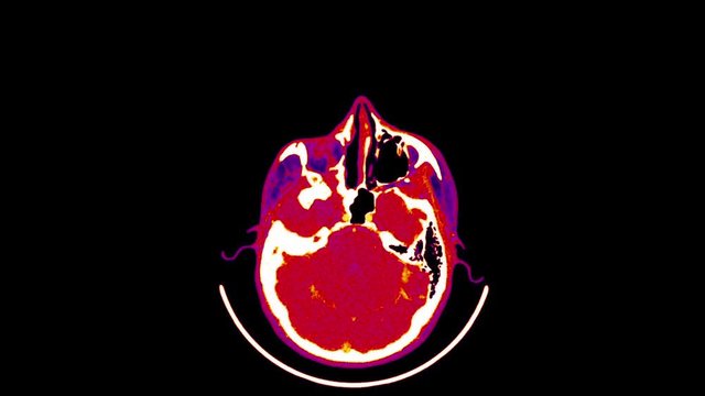 Magnetic Resonance Imaging of the Brain - CT Scan