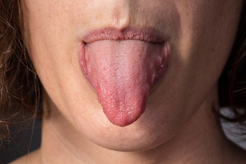 Girl showing to the doctor the tongue to examinate candidiasis