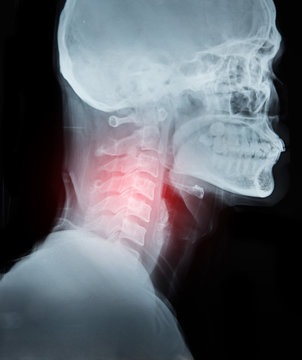 X-ray image film detail of neck and red zone pain.