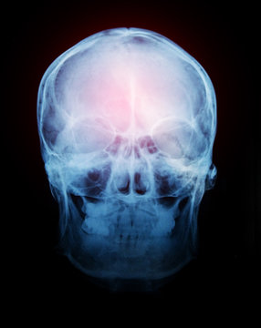 Film x-ray of human skull.