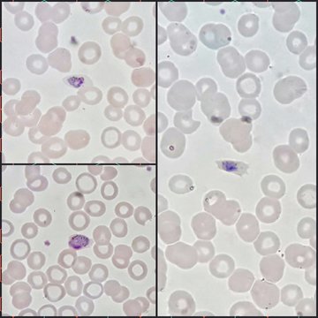 Three human parasite form patterns, trophozoite form of Plasmodium malariae malaria infected red blood cells on thin film blood smear under 100X light microscope (Selective focus).