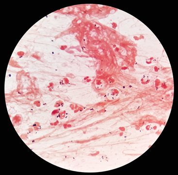 Smear of sputum specimen Gram's stained under 100X light microscope with many gram positive cocci bacteria (Selective focus).
