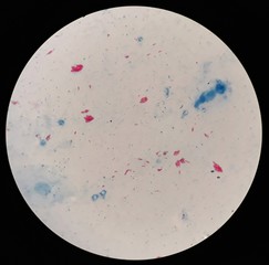 Smear of Acid-Fast bacilli (AFB) stained from cultured specimen with positive Mycobacterium...